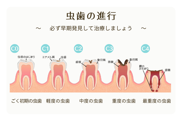 虫歯の進行