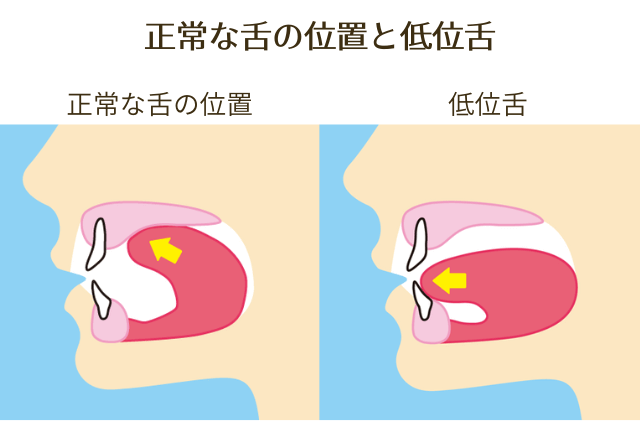 正常な舌の位置と低位舌