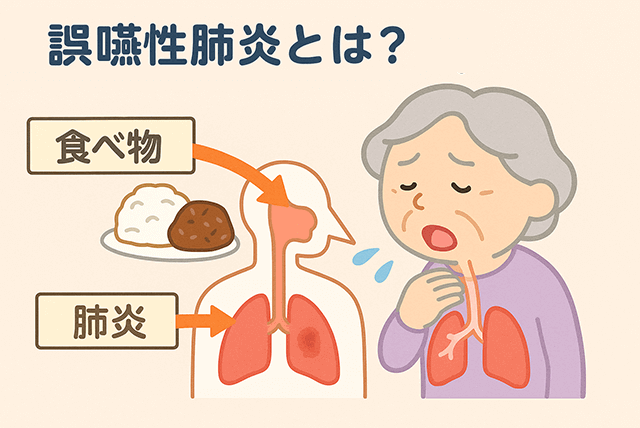誤嚥性肺炎とは?