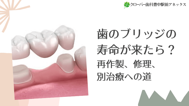 歯のブリッジの寿命が来たら？再作製、修理、別治療への道
