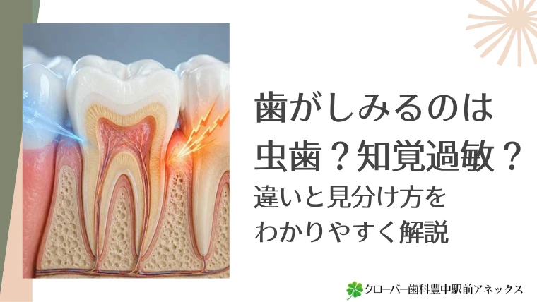 歯がしみるのは虫歯？知覚過敏？違いと見分け方をわかりやすく解説