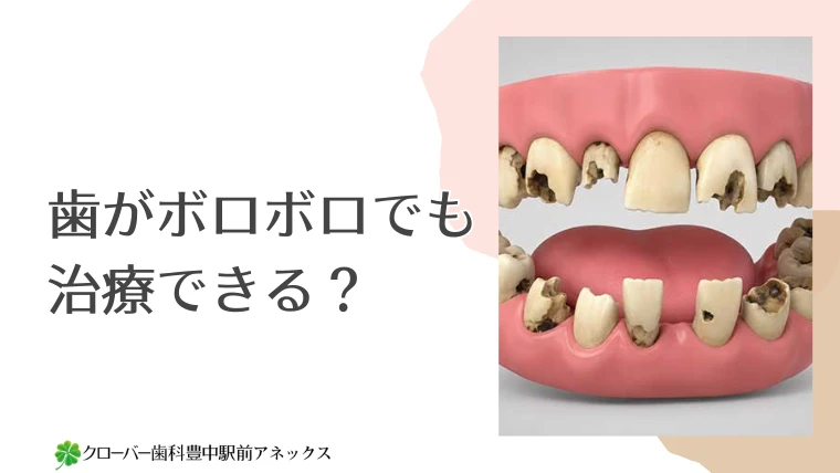 歯がボロボロでも治療できる？