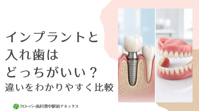 インプラントと入れ歯はどっちがいい？違いをわかりやすく比較