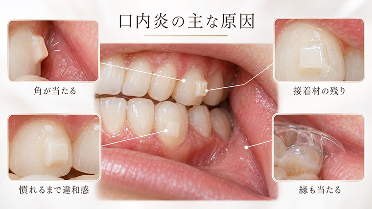口内炎の原因