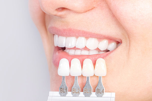 セラミック矯正